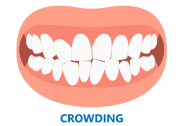 Close-up of crowded teeth with misalignment due to lack of space.