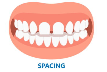 Close-up of teeth with noticeable spacing between them