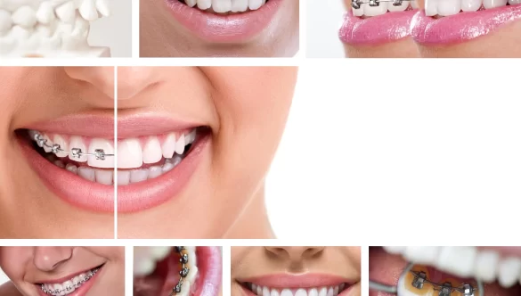 How Long Does Braces Treatment Take? Insights and Tips