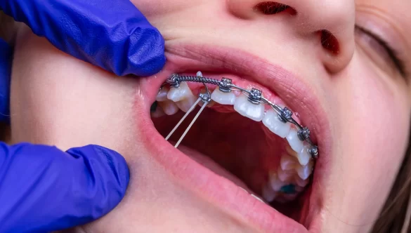 The Essential Guide to Braces and Rubber Bands: What You Need to Know