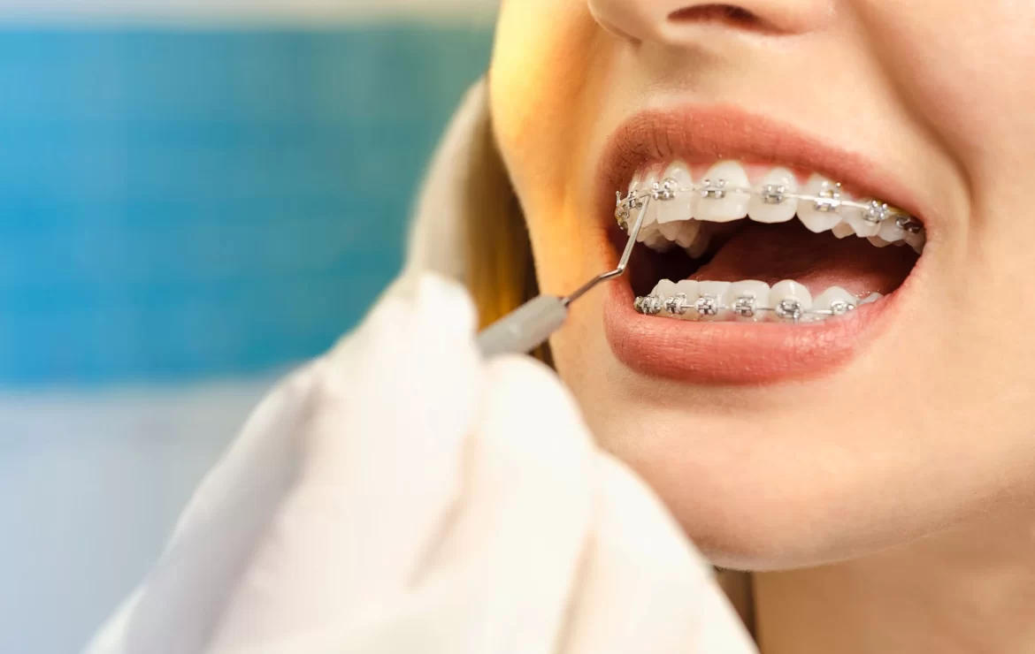 What to Do If a Bracket Comes Loose on Your Braces