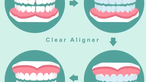 Understanding the Cost of Clear Aligners in Orland Park, IL