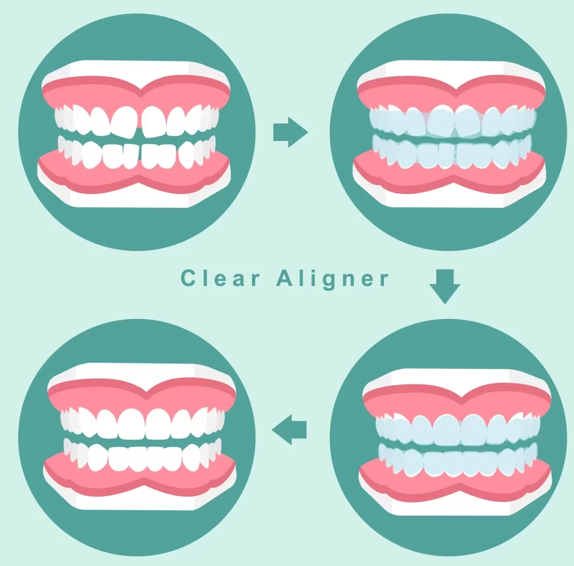 Understanding the Cost of Clear Aligners in Orland Park, IL