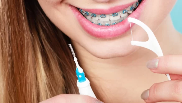 Navigating Your First Week with Braces: Essential Tips for a Smooth Transition