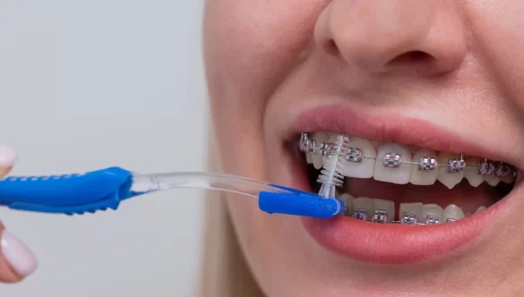 How to Clean Braces: Effective Methods