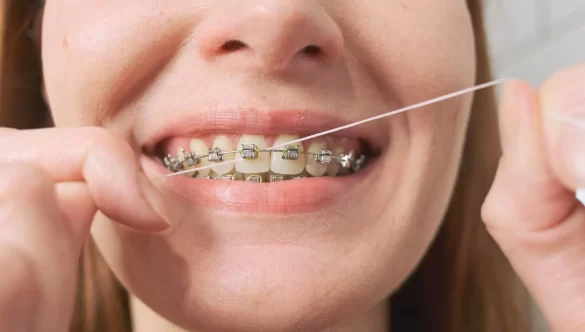 Mastering Flossing Techniques with Braces