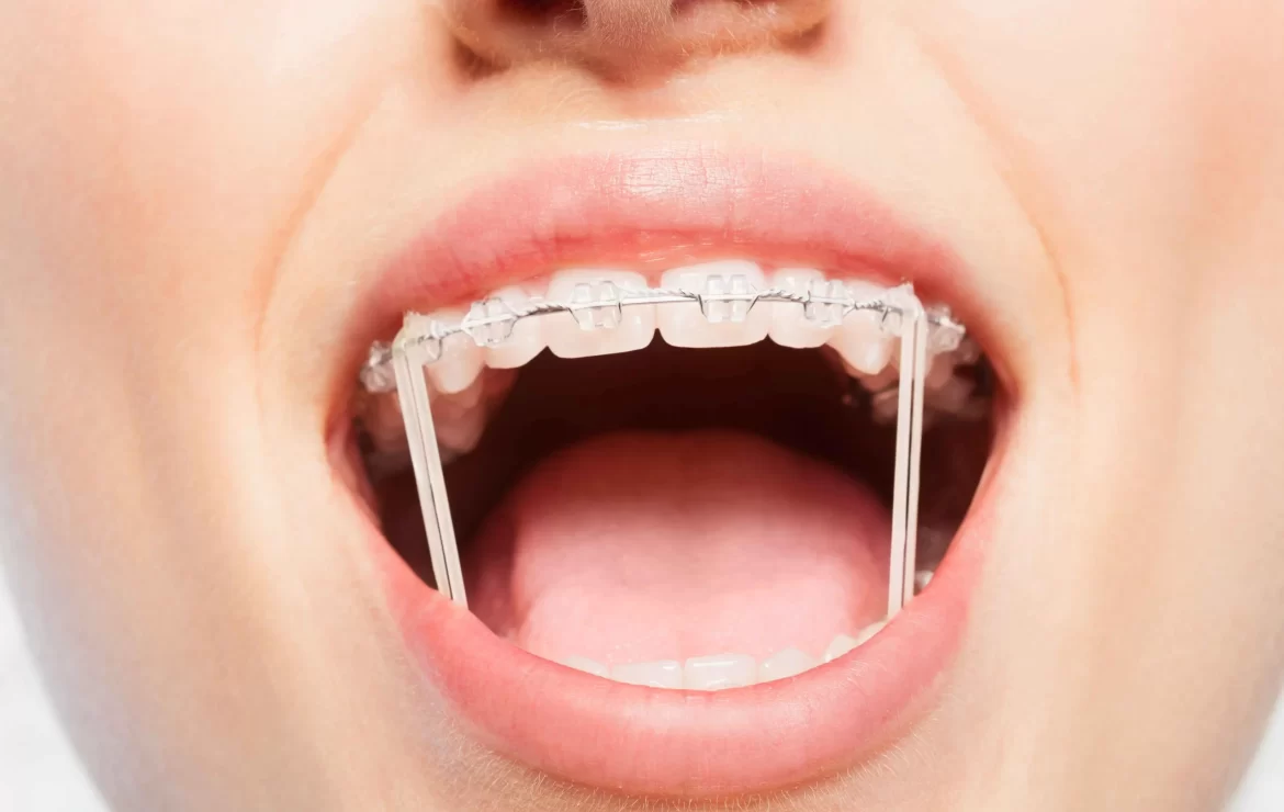 Why Consistent Rubber Band Wear is Essential for Orthodontic Success