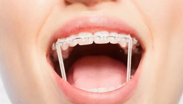 Why Consistent Rubber Band Wear is Essential for Orthodontic Success