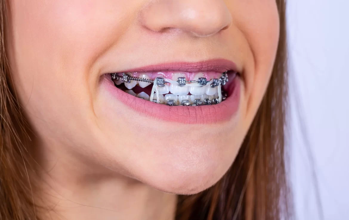 Can Braces Lead to Teeth Staining? What You Need to Know