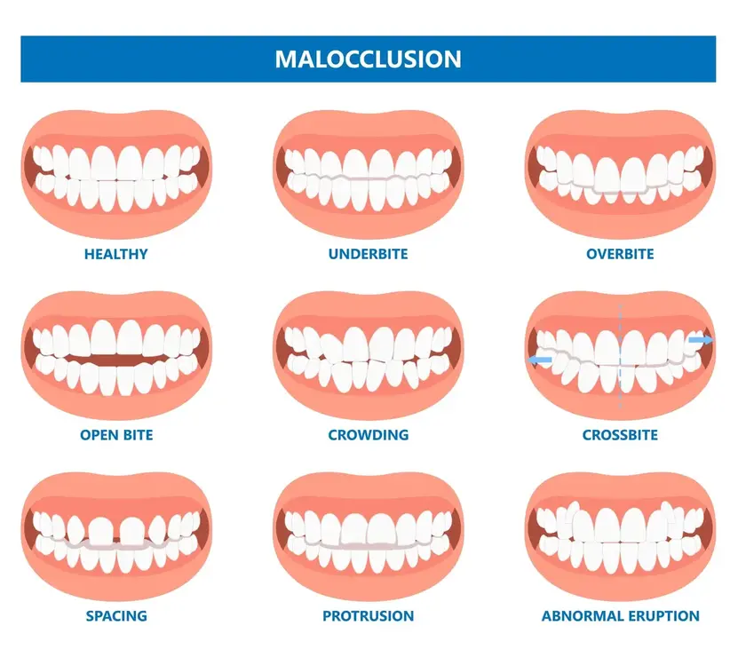 Understanding the Causes of Crooked Teeth and Malocclusions