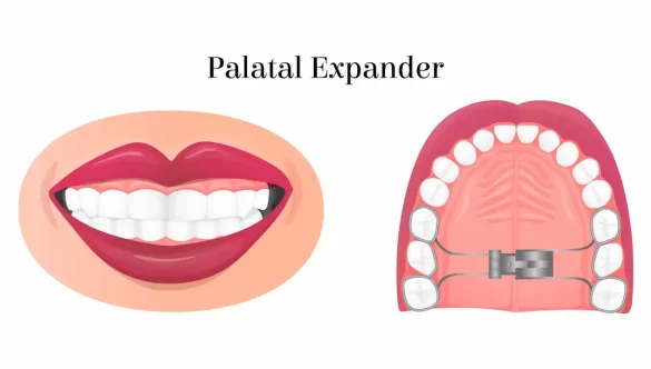 Understanding Palatal Expanders: What You Need to Know